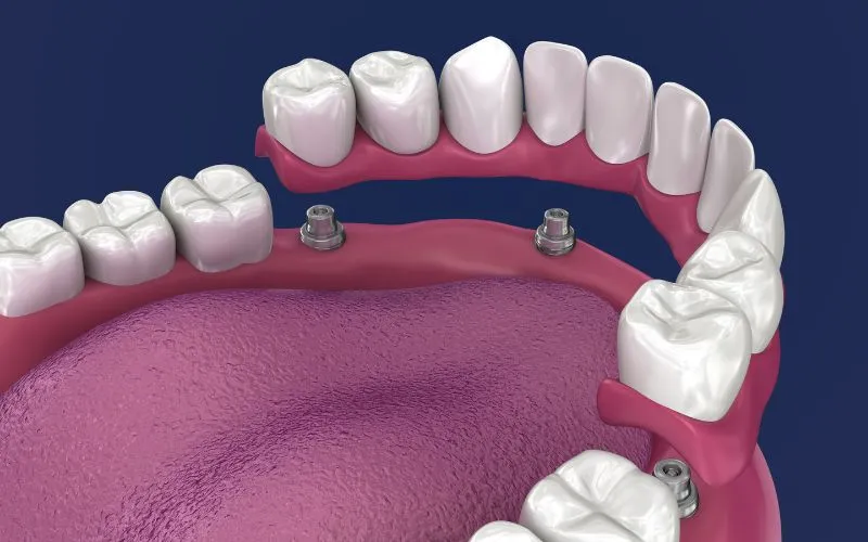 Exploring the Latest Innovations in Dentures
