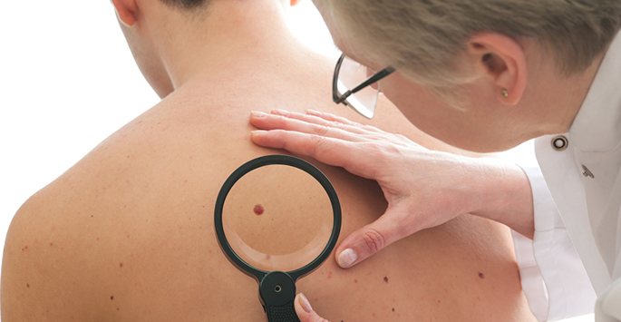 How Dermatologists Detect Skin Cancer Early