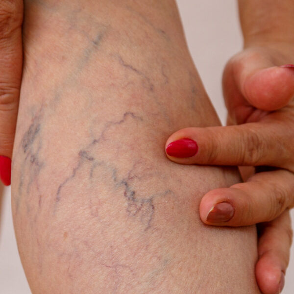 How Spider Veins Can Affect Your Health