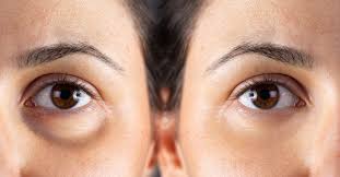 The Efficacy of Morpheus8 in Treating Various Skin Concerns