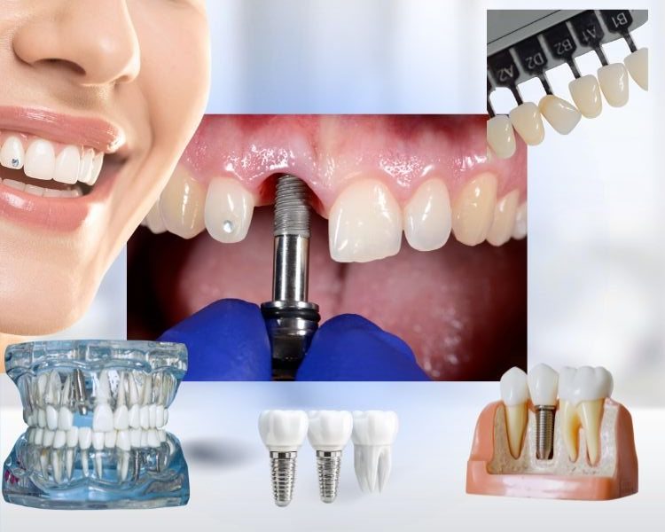 The Impact of Dental Implants on Quality of Life