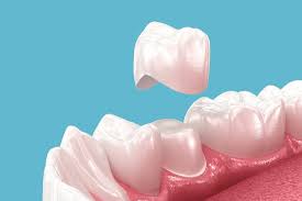 The Role of Crowns in Preventing Tooth Loss and Damage